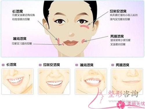 想要笑起来有酒窝，哪些手术方法可以形成酒窝