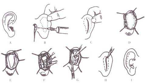 招风耳的矫正方法有哪些？