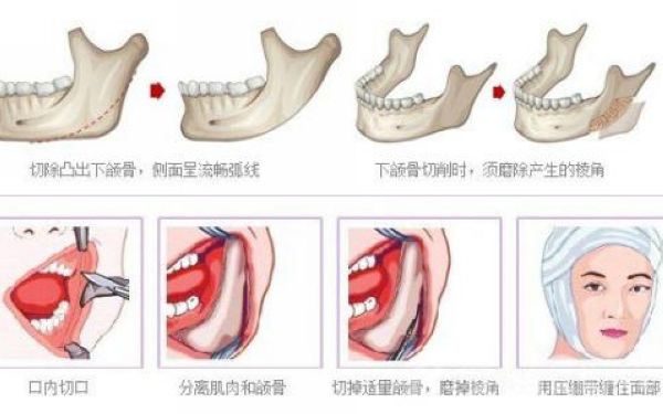 下<a href=http://www.mx185.com/listinfo-644-0.html target=_blank class=infotextkey>颌骨整形</a>危险吗