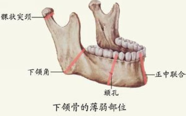 下颌骨骨折手术多少钱