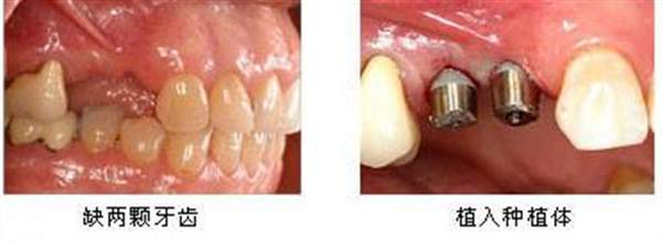 广州种植牙价格表