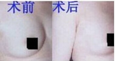 乳房肥大影响生活该怎么办