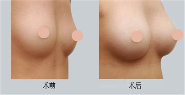 乳房拉皮案例手术后照片效果