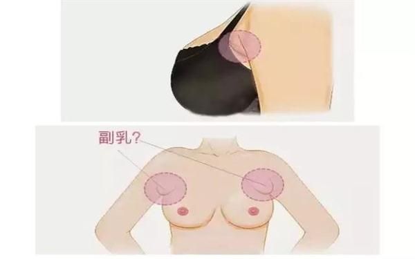 副乳切除手术多久恢复