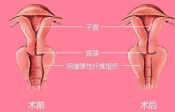 阴部整形前后对比