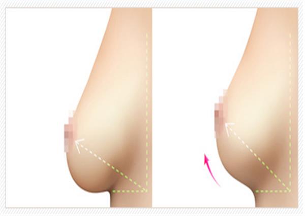 胸部下垂矫正费用